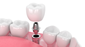 Aspen Dental Implants Aspen Smile Dentistry dentist in Aspen Colorado Dr. Jeremy Lowell Dr. Ian Lowell dental implants
