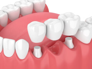 Render Of Jaw With Dental Bridge Over White Background